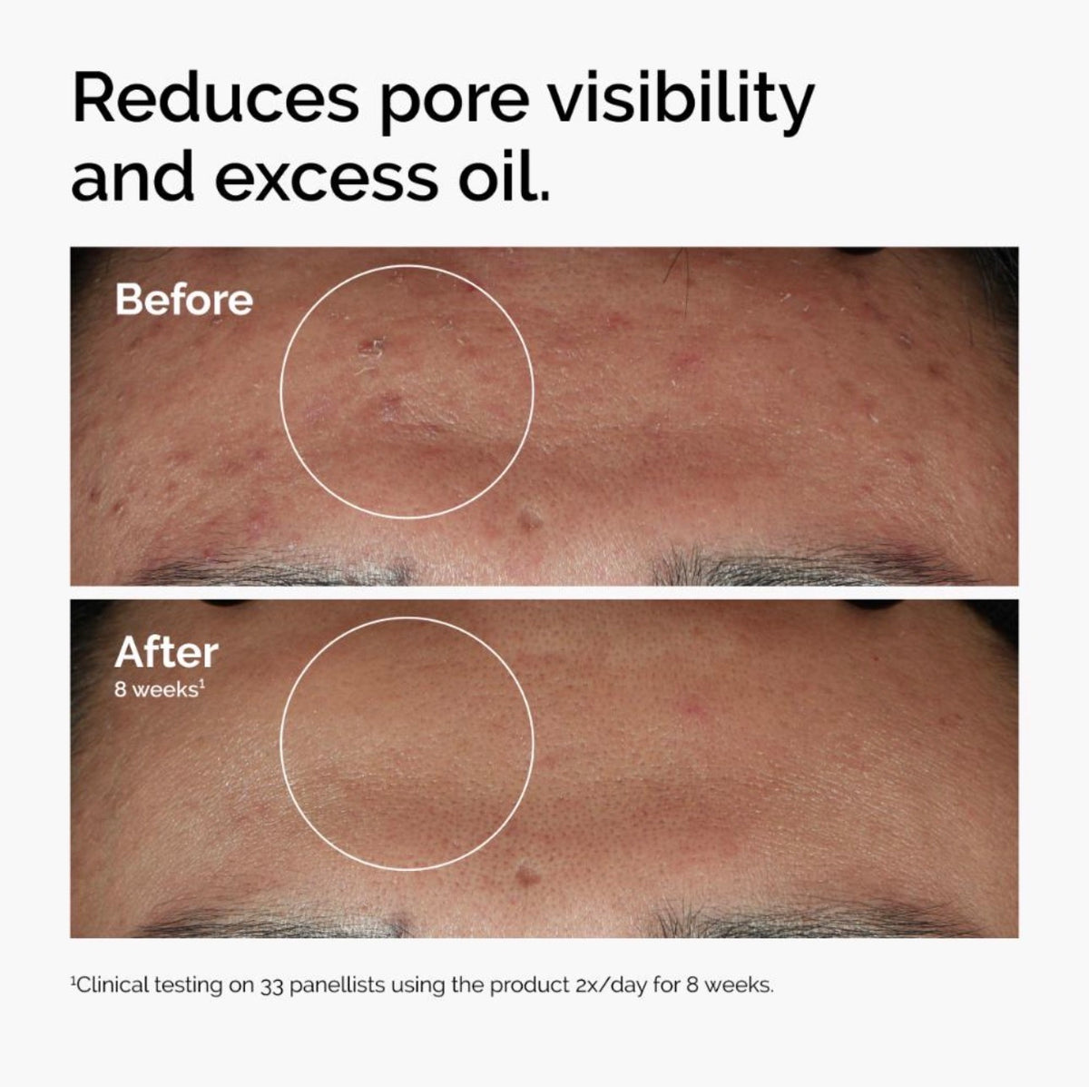 The Ordinary Niacinamide 10% + Zinc 1% Serum